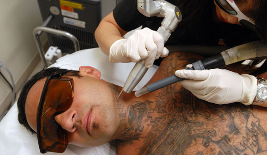 Is it possible to effectively get rid of unwanted tattoos