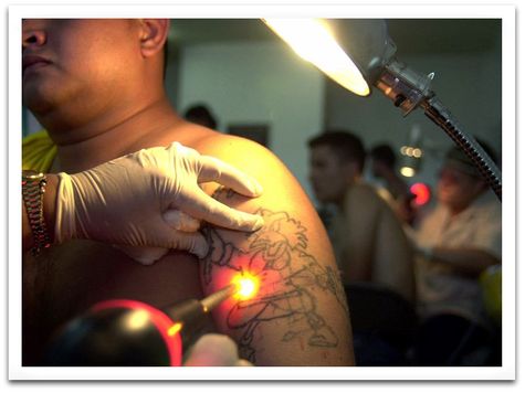 tattoo removaltattoolaser tattoo removal